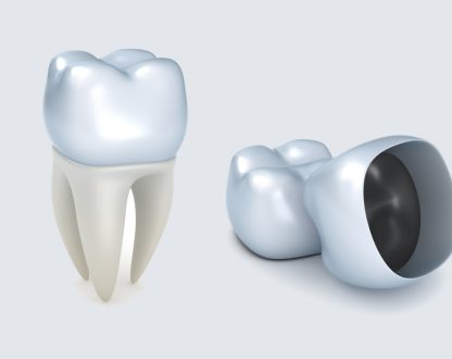 Dental Crowns: When and Why You Need Them?