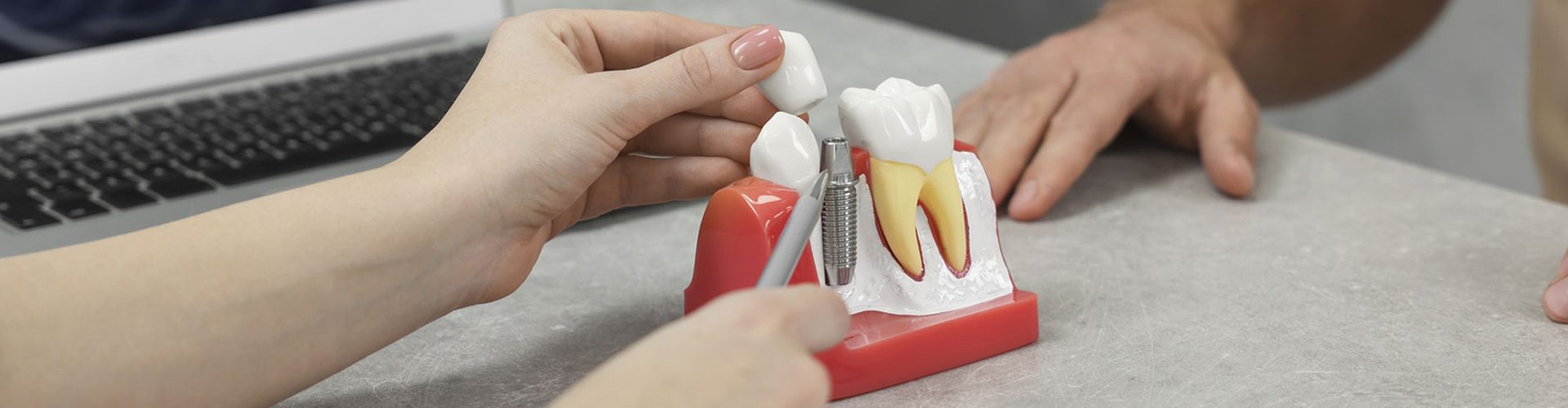 The Dental Implant Process: How We Restore Your Smile