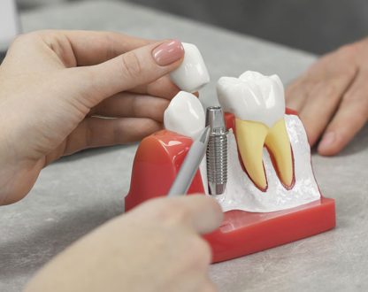 The Dental Implant Process: How We Restore Your Smile